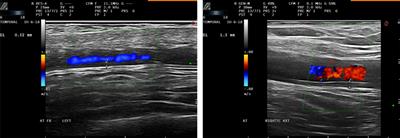 Ultrasound intima media thickness cut-off values for cranial and extracranial arteries in patients with suspected giant cell arteritis